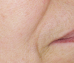 ほうれい線・口元のシワ(※60歳女性 12回)Before