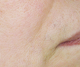 ほうれい線・口元のシワ(※60歳女性 12回)After