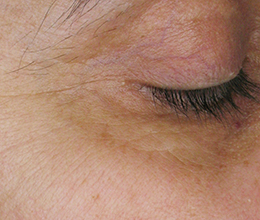 目の周りのシワBefore