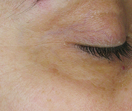 目の周りのシワAfter